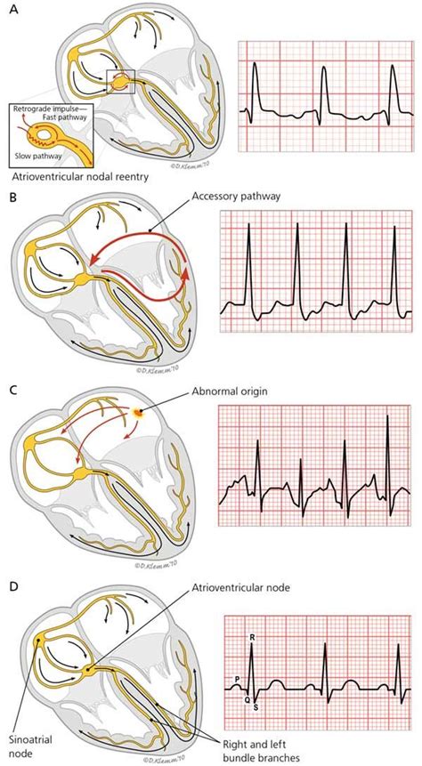 Diagnosis and Management of Common Types of Supraventricular ...