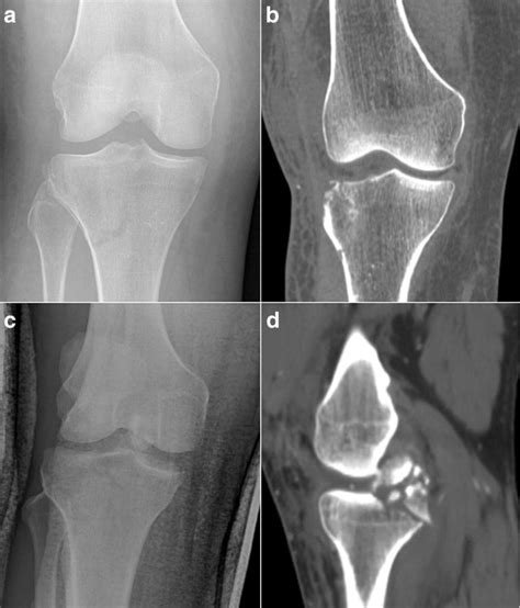 Examples of concomitant periarticular fractures in the setting of... | Download Scientific Diagram