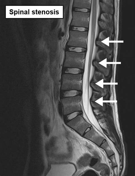 Spinal Canal Stenosis Mri - img-gimcrackery