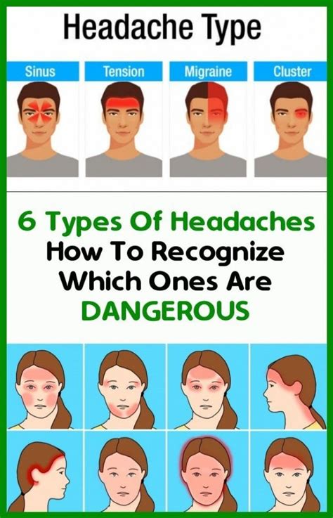 6 types of headaches: how to identify those who are dangerous in 2020 | Headache types, Headache ...