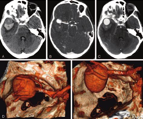 Temporal Artery Aneurysm