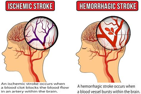 CVA stroke, causes, symptoms, diagnosis, treatment, recovery & prognosis