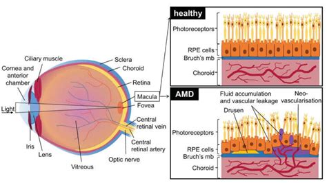 Schematic of the eye with healthy retina, choroid and retinal pigment... | Download Scientific ...