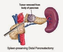 Distal Pancreatectomy – Pancreatic Surgery, when Pancreas Tail and Body are Removed - Pancreatic ...