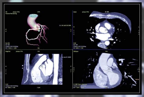 Coronary Angiography: Procedure - Engiomed