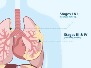 Pleural Mesothelioma | Causes, Symptoms, Treatment and Top Doctors