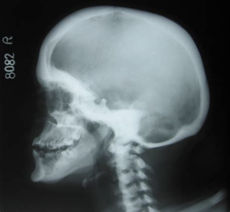 OSTEOPETROSIS (Albers-Schonberg Disease) - Dr. Vasu