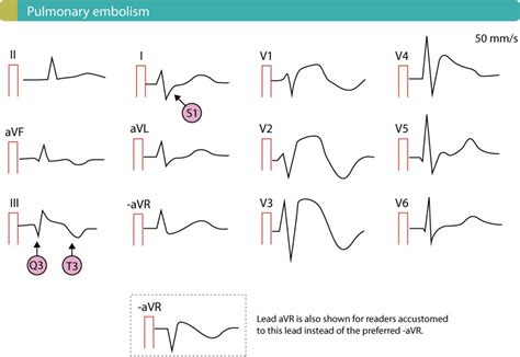 Pulmonary Embolism (PE): Causes, symptoms, diagnosis, treatment