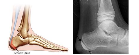 Severs Disease (Calcaneal Apophysitis) - Ankle, Foot and Orthotic Centre