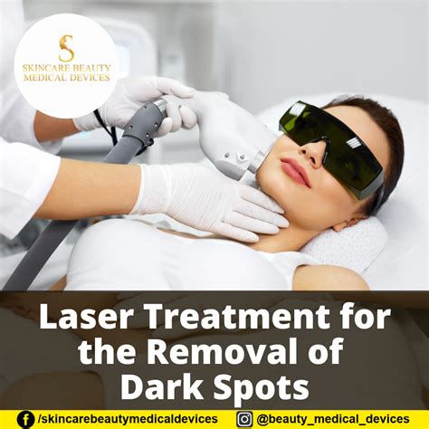 Laser Treatment for the Removal of Dark Spots