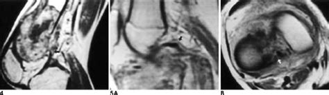 A 18-year-old man with osteosarcoma in the distal femur. Enhanced ...