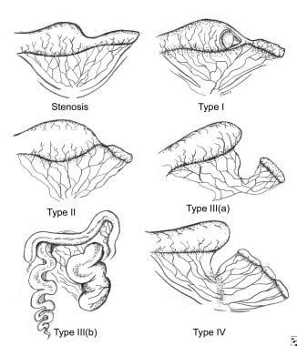 Jejunoileal Stenosis and Atresia ~ Medical science and health