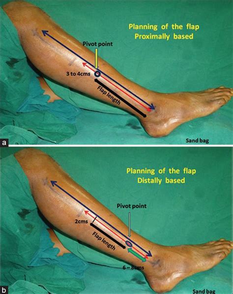 (a) Skin markings for raising the proximally based peroneus brevis... | Download Scientific Diagram