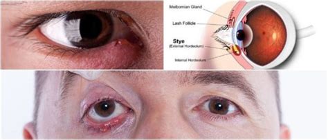 Stye (Boil on Eyelid): Causes, Symptoms, Diagnosis, Treatment - Hoool Health & Wellness