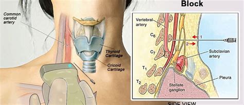 Stellate Ganglion Block Ultrasound Guided Operation