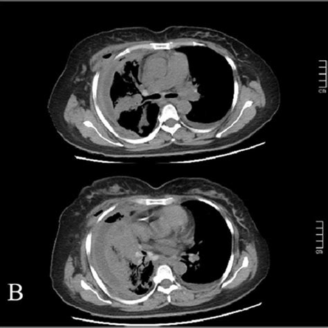 Tracheal Carina (a), right common bronchus (b), right intermediate... | Download Scientific Diagram