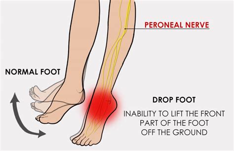 Foot Drop - Orchard Health Clinic - Osteopathy, Physiotherapy and Chiropractic