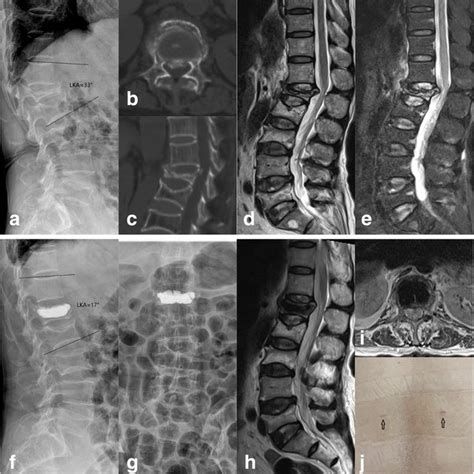 Anteroposterior and lateral X-ray (a and b) after L4 kyphoplasty using... | Download Scientific ...