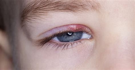 Stye Treatment: How to get rid of a stye in two steps