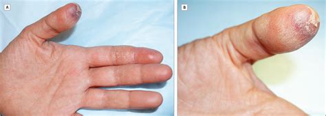 Fingertip Purpura in a Dental Student: An Unusual Manifestation of Methyl Methacrylate ...