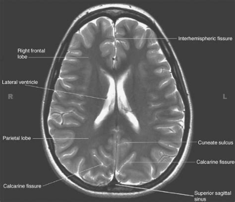 Introduction to Brain Imaging | Radiology Key