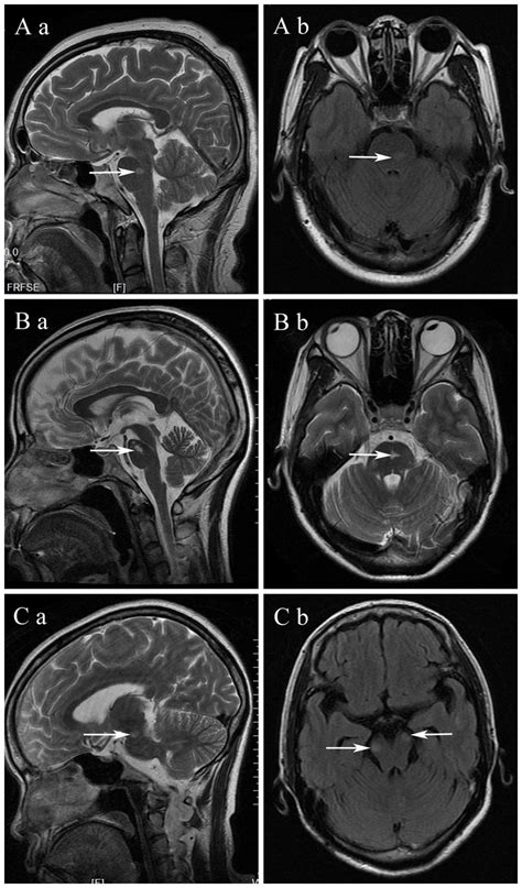 Brain stem lesions (arrows) on MRI of multiple sclerosis (MS). (A, B)... | Download Scientific ...