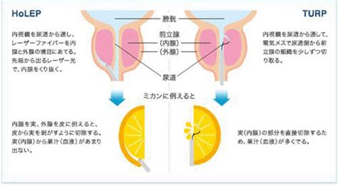 前立腺肥大症の治療～HoLEPとは？｜泌尿器科｜上尾中央総合病院