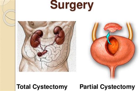 Partial / Radical Cystectomy Surgery in India : Cost, Hospitals & Doctor