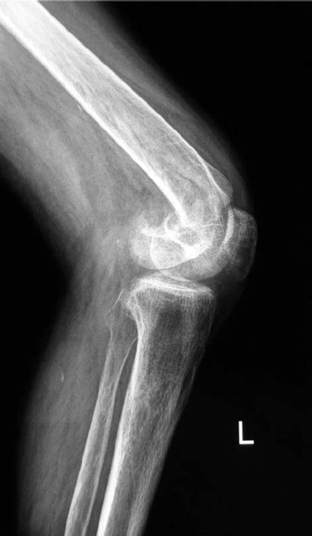 Distal femoral fracture, lateral view. | Download Scientific Diagram