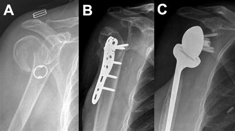 Mechanisms Of Humeral Head Fracture