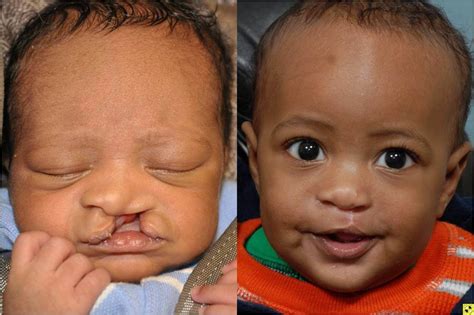 Cleft Lip and Cleft Palate | Johns Hopkins Facial Plastic and Reconstructive Surgery