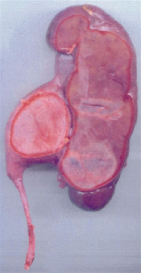 Extrarenal Pelvis