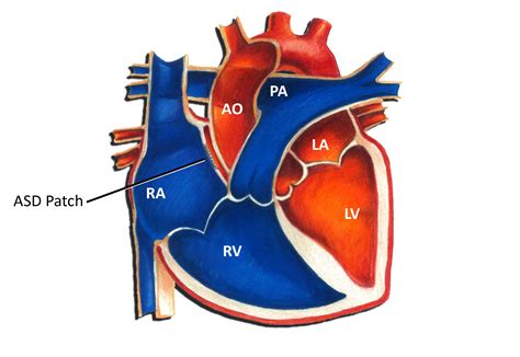 Atrial Septal Defect - Pediatric Heart Specialists