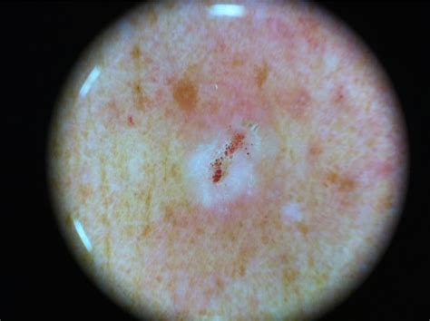 Squamous cell carcinoma (SCC) - pictures - cancer photos - Dermatology