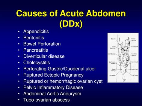 PPT - The Acute Abdomen PowerPoint Presentation - ID:173923