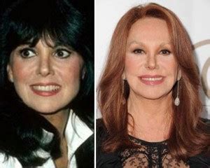 Marlo Thomas Plastic Surgery Is Too Obvious To Deny Any More - Plastic ...