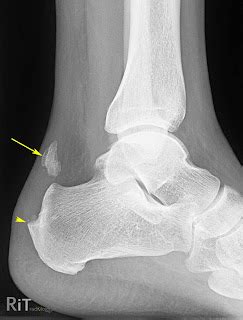 RiT radiology: Achilles Tendon Rupture