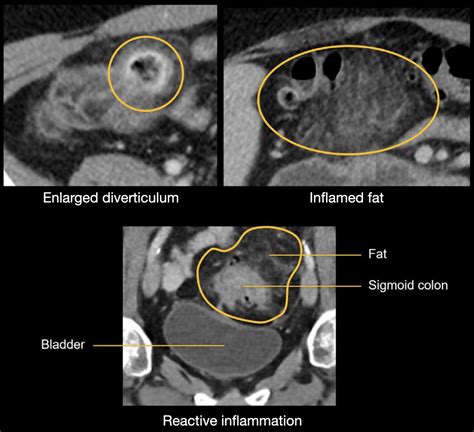 Abdominal CT: diverticulitis • LITFL • Radiology Library