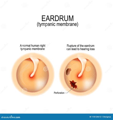 Ruptured Perforated Eardrum Stock Vector - Illustration of biology ...