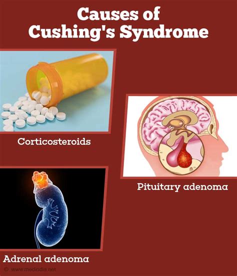 Cushing's Syndrome - Causes, Symptoms, Diagnosis and Management