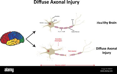 Diffuse Axonal Injury Stock Photo - Alamy