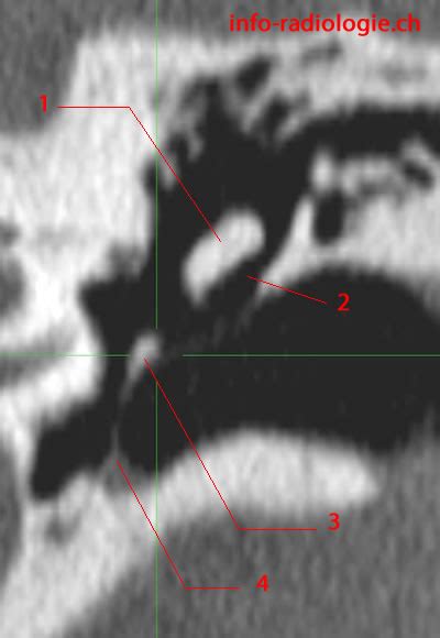 Prussak Space Ct Scan