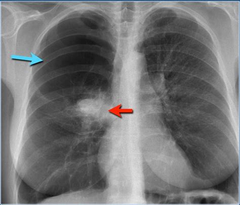 Chest X Ray Pneumonia Vs Bronchitis