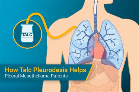 How Talc Pleurodesis Treats Pleural Mesothelioma