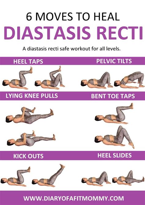 Can I Exercise With Diastasis Recti - Exercise Poster