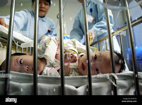 TWINS SUCCESSFULLY SEPERATED Doctors spent hours separating these three ...