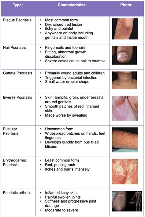 Psoriasis Awareness Month - Innovative Trials