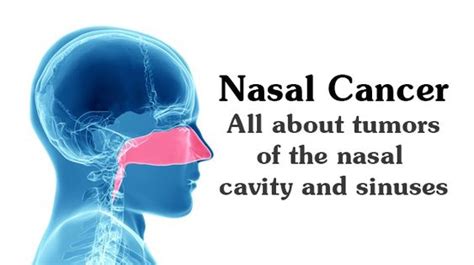 Nasal Cancer: All About Tumors of the Nasal Cavity & Sinuses - wikiJunkie