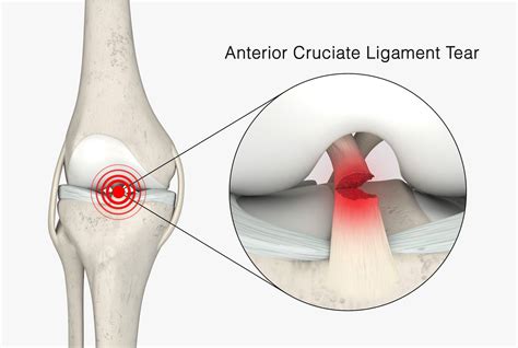 ACL Tear Surgery & Information | Colorado Springs Sports Doctor