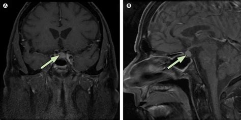 Autoimmune hypophysitis - The Lancet Oncology